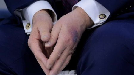 Загадкові плями у Давосі: здоров’я Трампа знову під прицілом камер